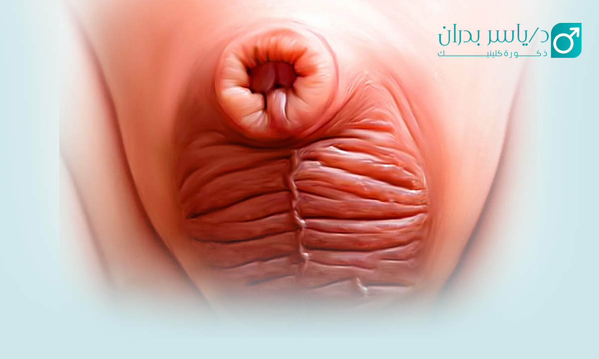 علاج-القضيب-المدفون