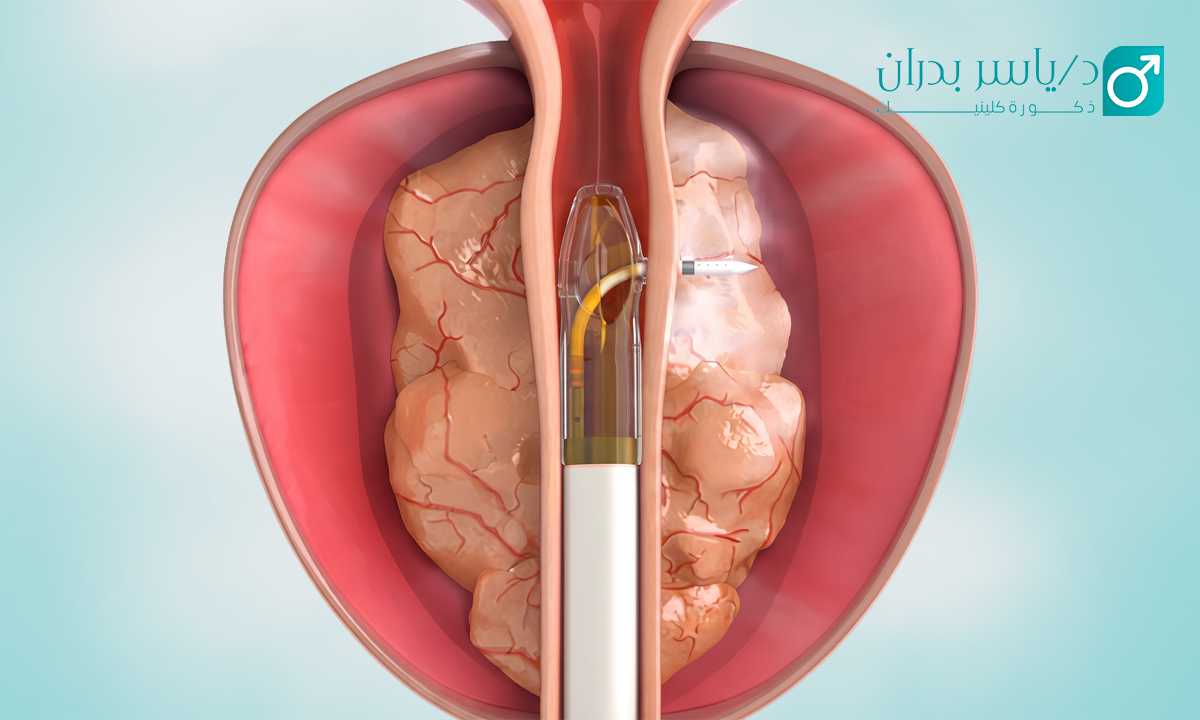علاج-تضخم-البروستاتا-بالليزر
