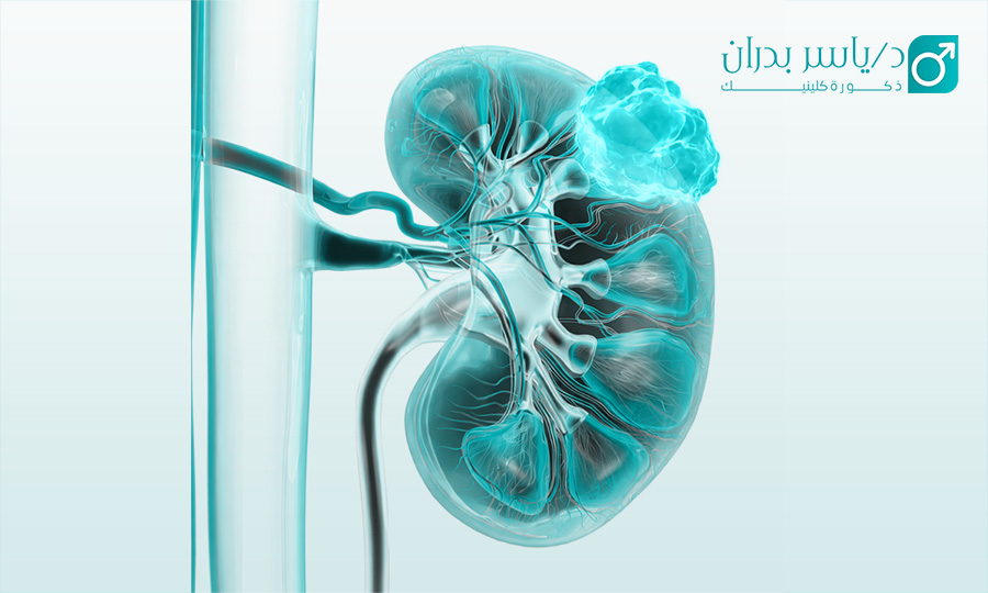 ما هي اعراض سرطان البروستاتا  ما هي أول علامات سرطان الكلى؟